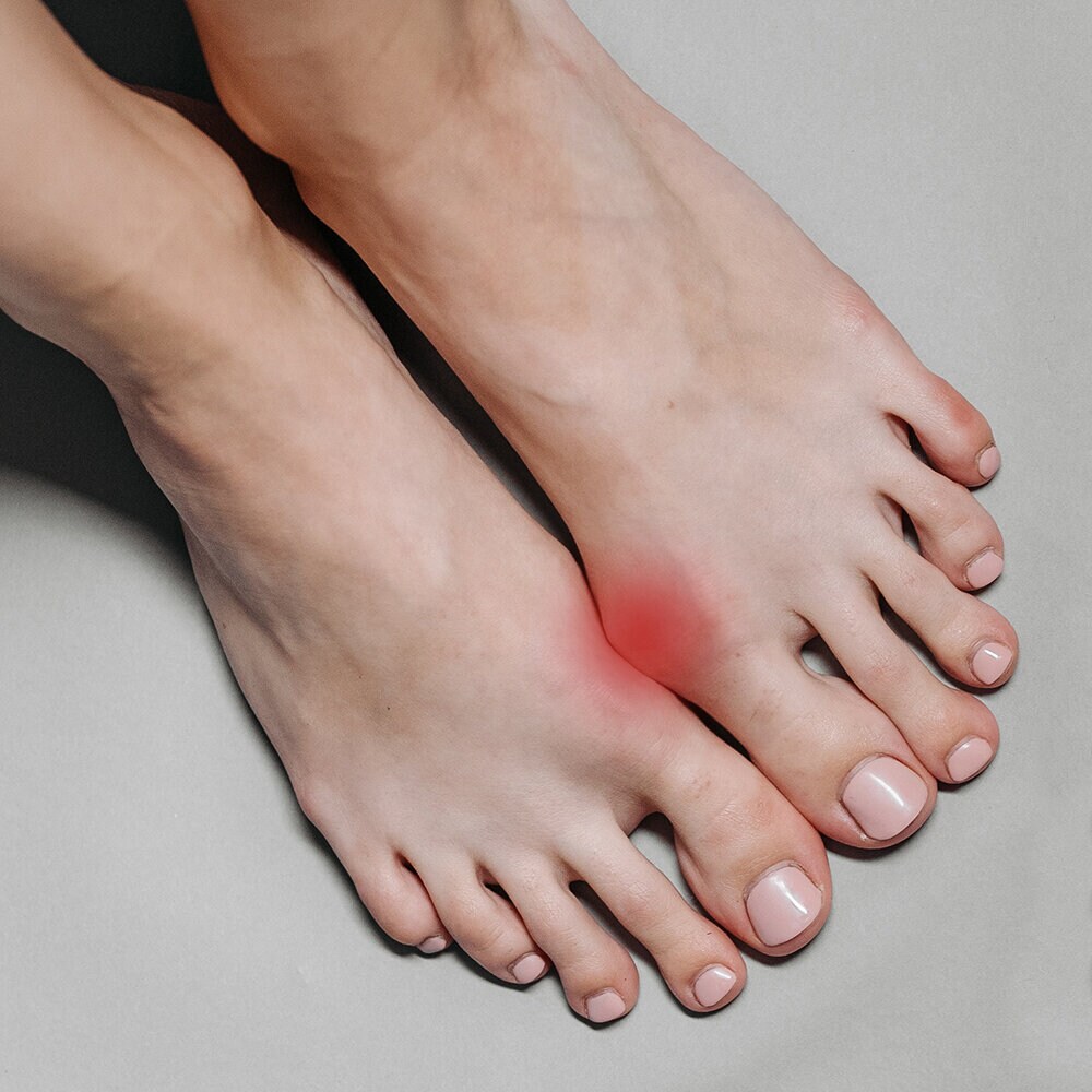 https://www.flawlesswalk.com/pub_docs/files/404content/hallux-valgus.jpg